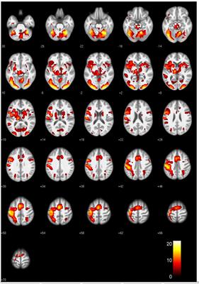 Emotional Word Processing in Patients With Juvenile Myoclonic Epilepsy